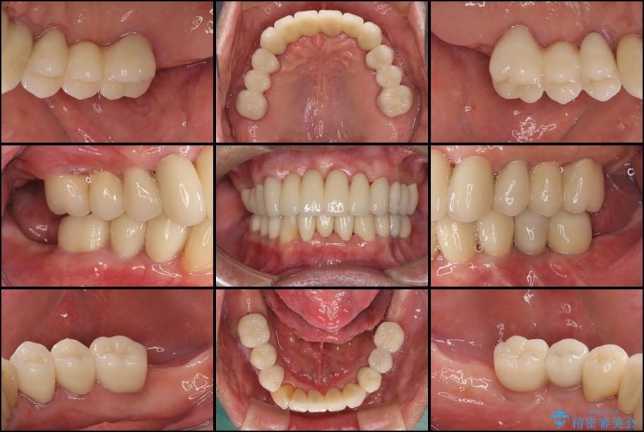 ボロボロの歯を何とかしたい　総合歯科治療による全顎治療 治療後
