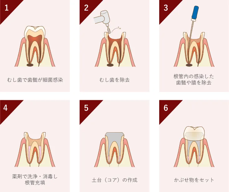 精密根管治療の流れ