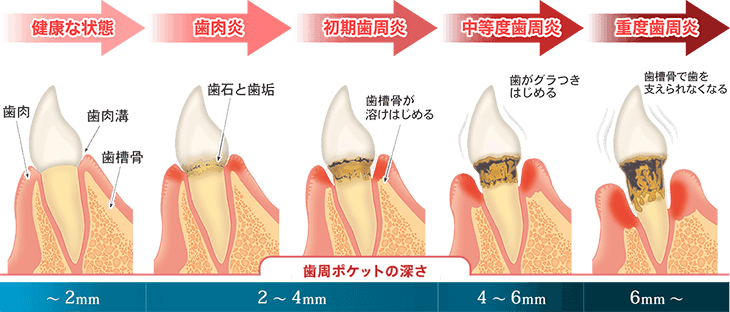 歯周病の進行度合