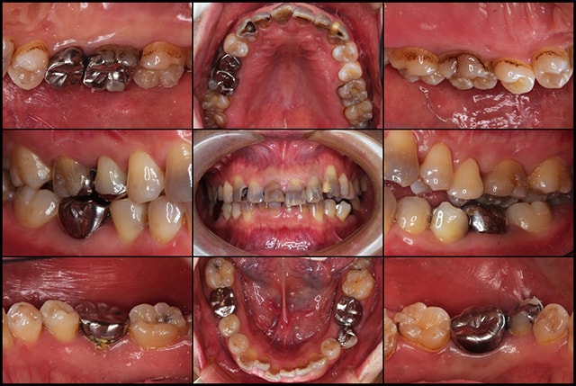 着色歯と歯並びを改善した総合歯科治療 治療前
