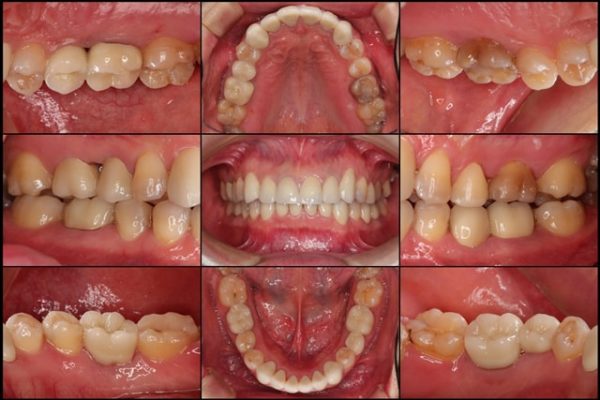 着色歯と歯並びを改善した総合歯科治療 治療後画像