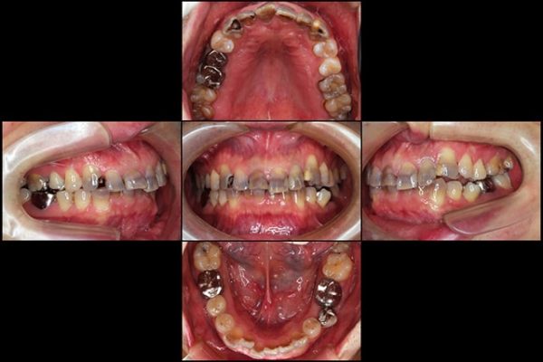 着色歯と歯並びを改善した総合歯科治療 治療前画像