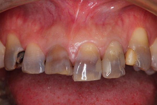 着色歯と歯並びを改善した総合歯科治療 治療前画像