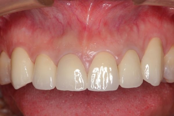 着色歯と歯並びを改善した総合歯科治療 治療後画像