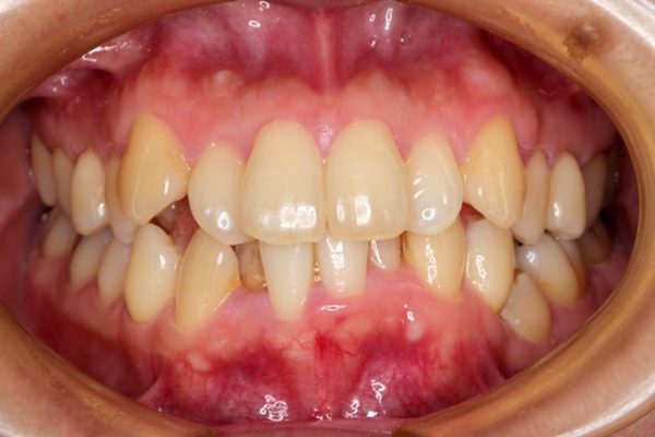 短期間で終了した矯正歯科治療 治療例 治療前画像