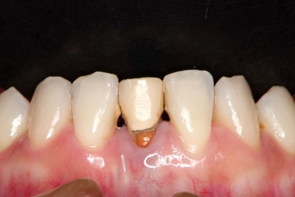 前歯のオールセラミック 治療例 治療前画像