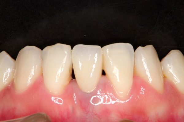 前歯のオールセラミック 治療例 治療後画像