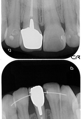 前歯のオールセラミック 治療例 治療前画像