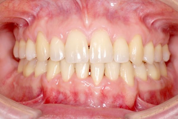 八重歯とクロスバイトの矯正 治療例 アフター