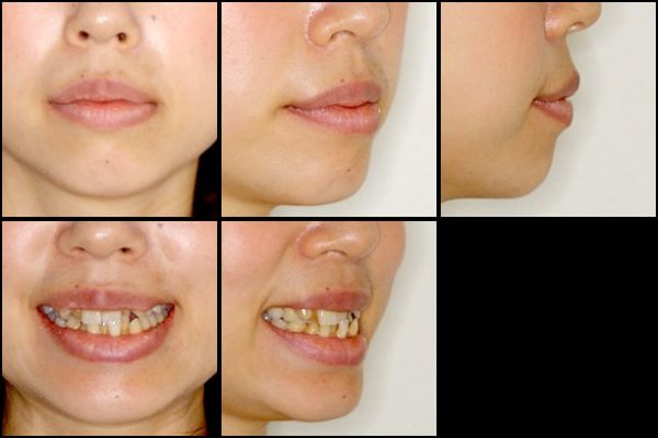 八重歯とクロスバイトの矯正 治療例 治療前画像