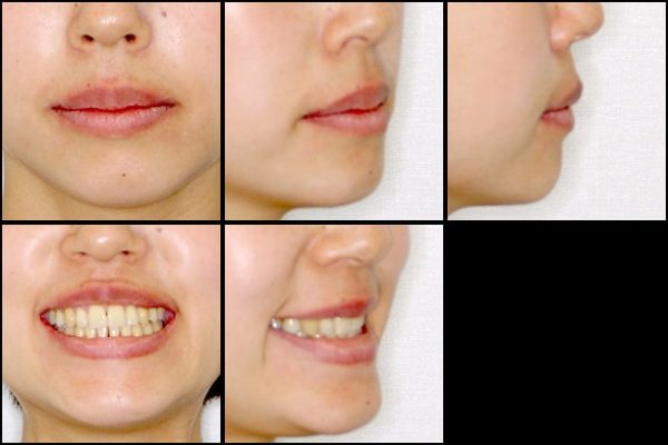 八重歯とクロスバイトの矯正 治療例 治療後画像
