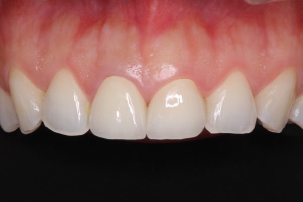 前歯2本のオールセラミック 治療例 アフター
