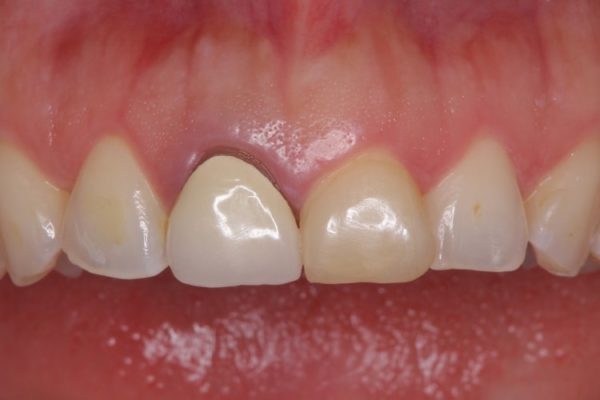 前歯2本のオールセラミック 治療例 治療前画像