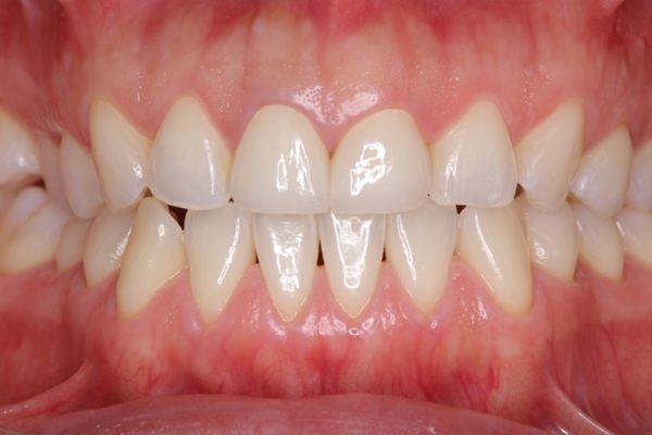 前歯2本のオールセラミック 治療例 治療後画像