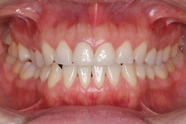 前歯2本のオールセラミック 治療例 治療後画像