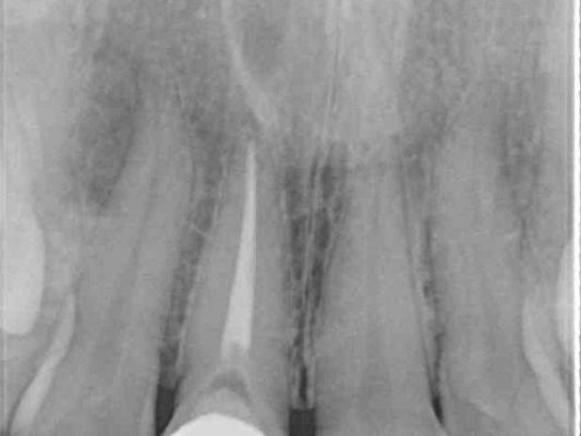 前歯2本のオールセラミック 治療例 治療前画像
