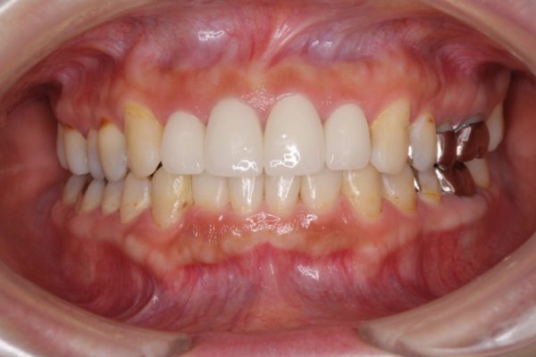 インビザライン矯正治療と前歯のセラミック治療 治療例 アフター