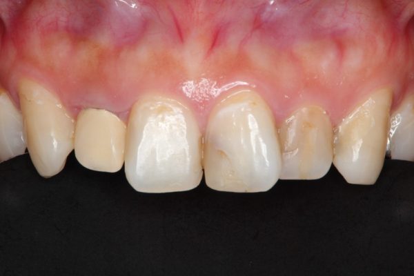 インビザライン矯正治療と前歯のセラミック治療 治療例 治療前画像