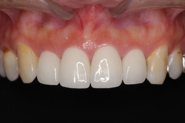 インビザライン矯正治療と前歯のセラミック治療 治療例 治療後画像