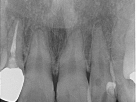 インビザライン矯正治療と前歯のセラミック治療 治療例 治療前画像