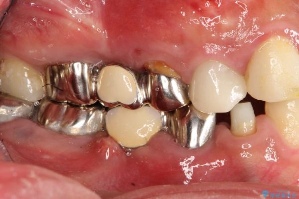 奥歯のインプラント治療 治療例 ビフォー