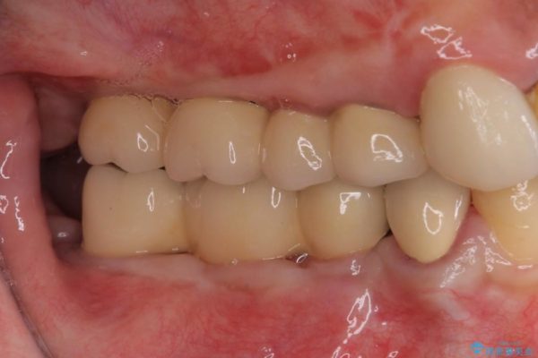 奥歯のインプラント治療 治療例 治療後画像