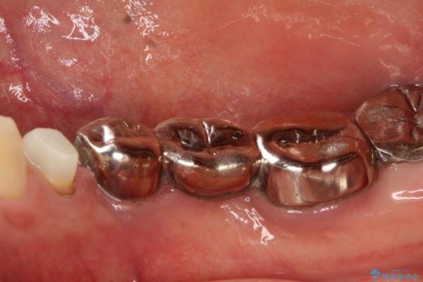 奥歯のインプラント治療 治療例 治療前画像