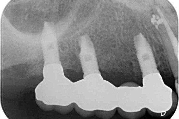 奥歯のインプラント治療 治療例 治療後画像