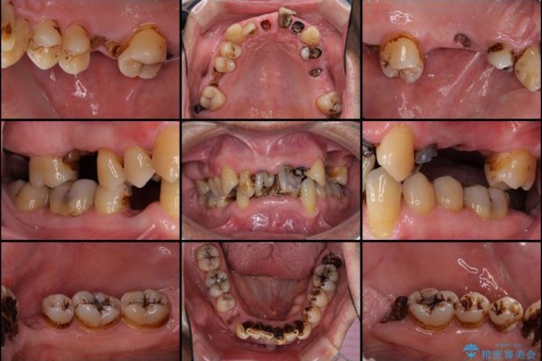 ほぼ全歯のインプラント、ブリッジ、セラミック治療例 治療前画像