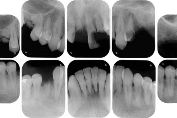 ほぼ全歯のインプラント、ブリッジ、セラミック治療例 治療前画像
