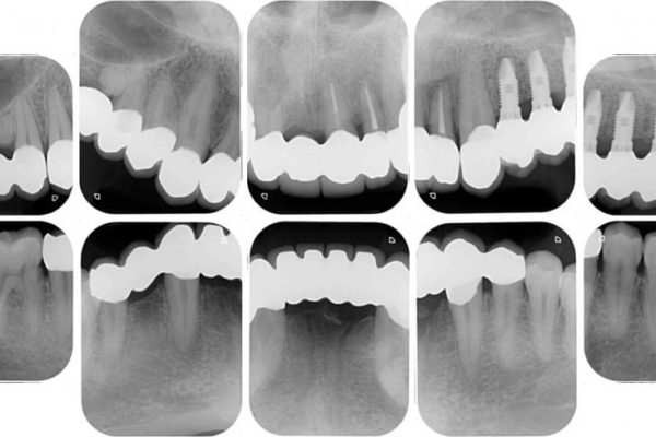 ほぼ全歯のインプラント、ブリッジ、セラミック治療例 治療後画像
