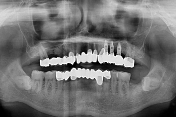 ほぼ全歯のインプラント、ブリッジ、セラミック治療例 治療後画像