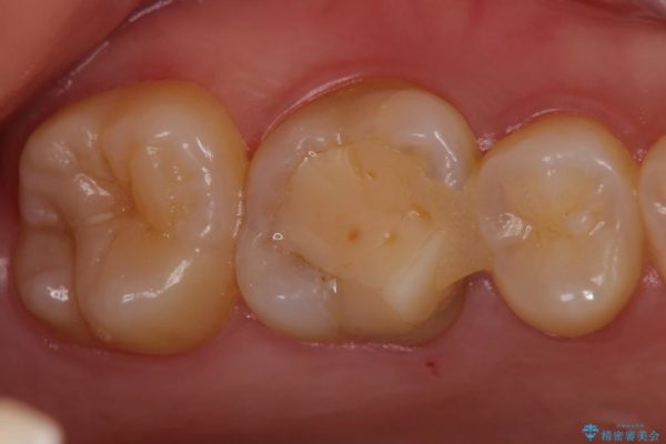欠けた奥歯のゴールドクラウン治療例 治療前画像