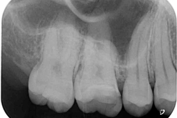 欠けた奥歯のゴールドクラウン治療例 治療前画像