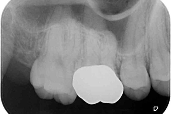 欠けた奥歯のゴールドクラウン治療例 治療後画像