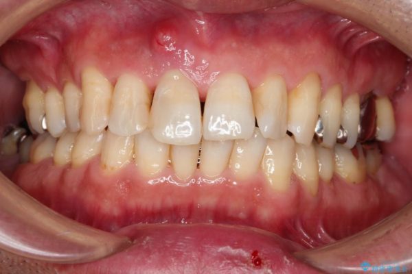 歯周病治療 歯槽骨の再生治療 治療例 治療前画像