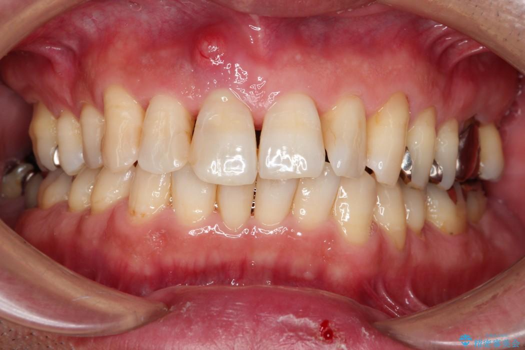 歯周病治療 歯槽骨の再生治療 治療例 治療前