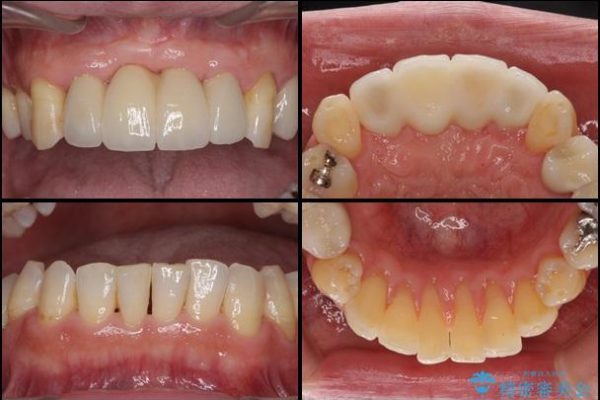 歯周病治療 歯槽骨の再生治療 治療例 治療後画像