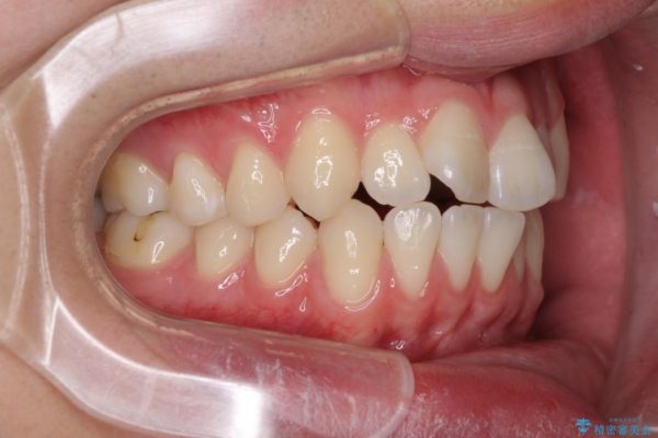 前歯のインビザラインによる短期間矯正 ビフォー