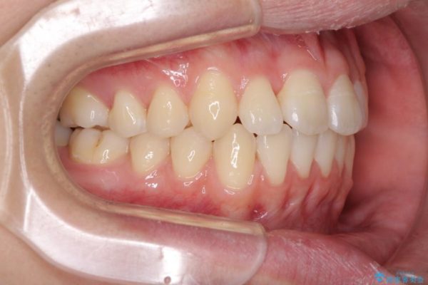 前歯のインビザラインによる短期間矯正 アフター