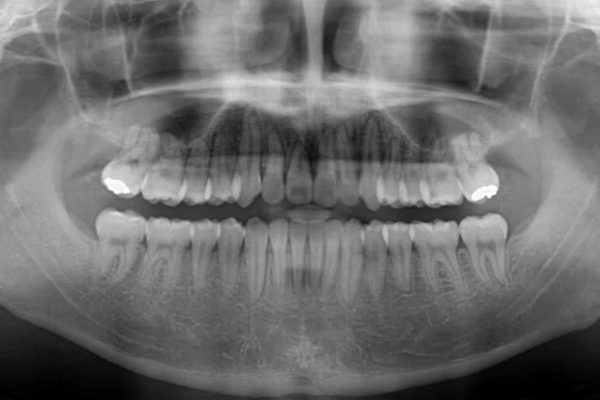 前歯のインビザラインによる短期間矯正 治療後画像