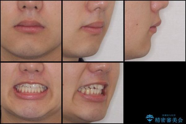前歯のインビザラインによる短期間矯正 治療前画像