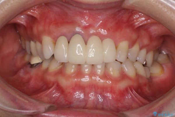 前歯の総合歯科治療（矯正、歯周病、セラミック）の治療例 治療後画像