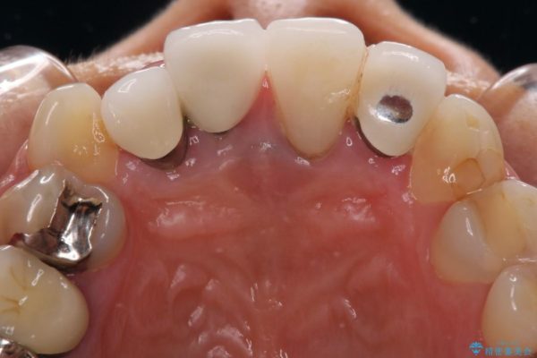 前歯の総合歯科治療（矯正、歯周病、セラミック）の治療例 治療前画像