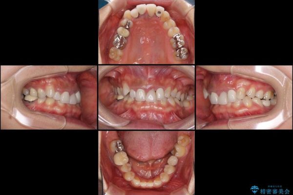 前歯の総合歯科治療（矯正、歯周病、セラミック）の治療例 治療前画像