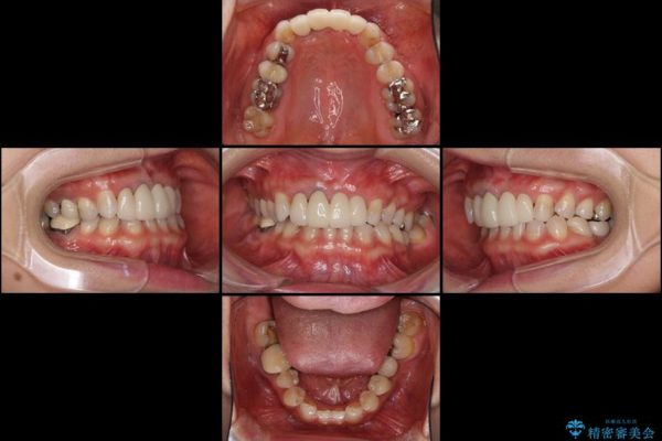 前歯の総合歯科治療（矯正、歯周病、セラミック）の治療例 治療後画像