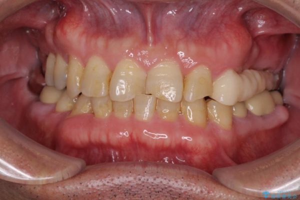 インビザラインliteによる切端咬合の歯列矯正 治療例 治療前画像