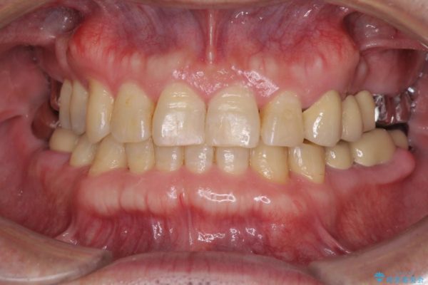 インビザラインliteによる切端咬合の歯列矯正 治療例 治療後画像