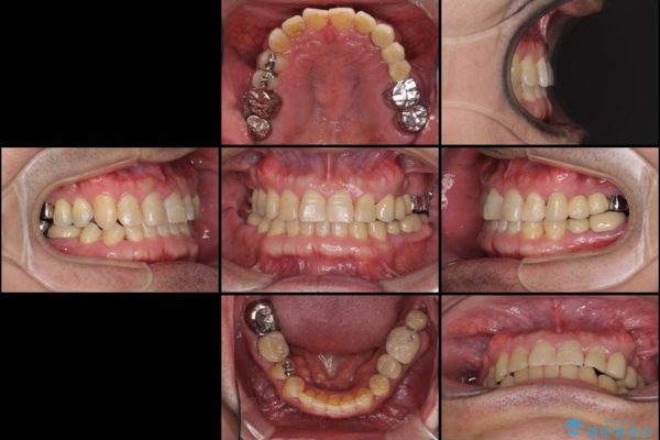 インビザラインliteによる切端咬合の歯列矯正 治療例 治療後画像