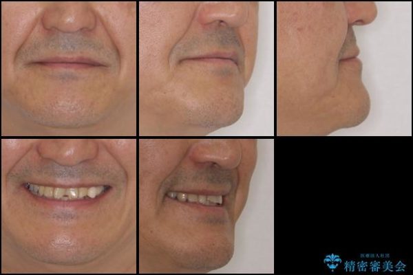インビザラインliteによる切端咬合の歯列矯正 治療例 治療前画像
